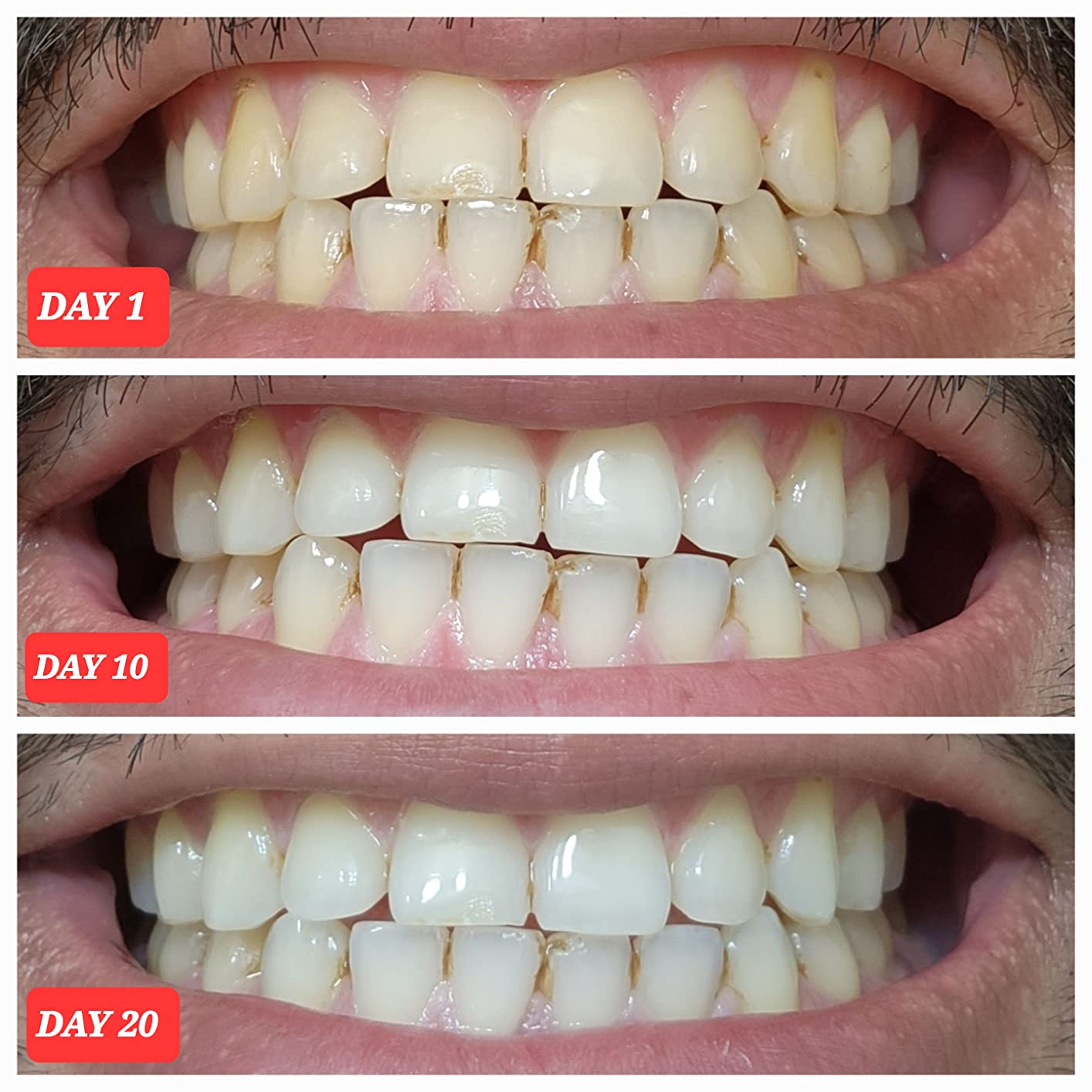 Crest 3D Whitestrips Professional Effects – Teeth Whitening Kit, 22 Treatments (20 + 2 Bonus), Each with 1 Upper/1Lower, 44 Strips – Crest 3DWhite Teeth Whitening Strips - Customer Photo 1