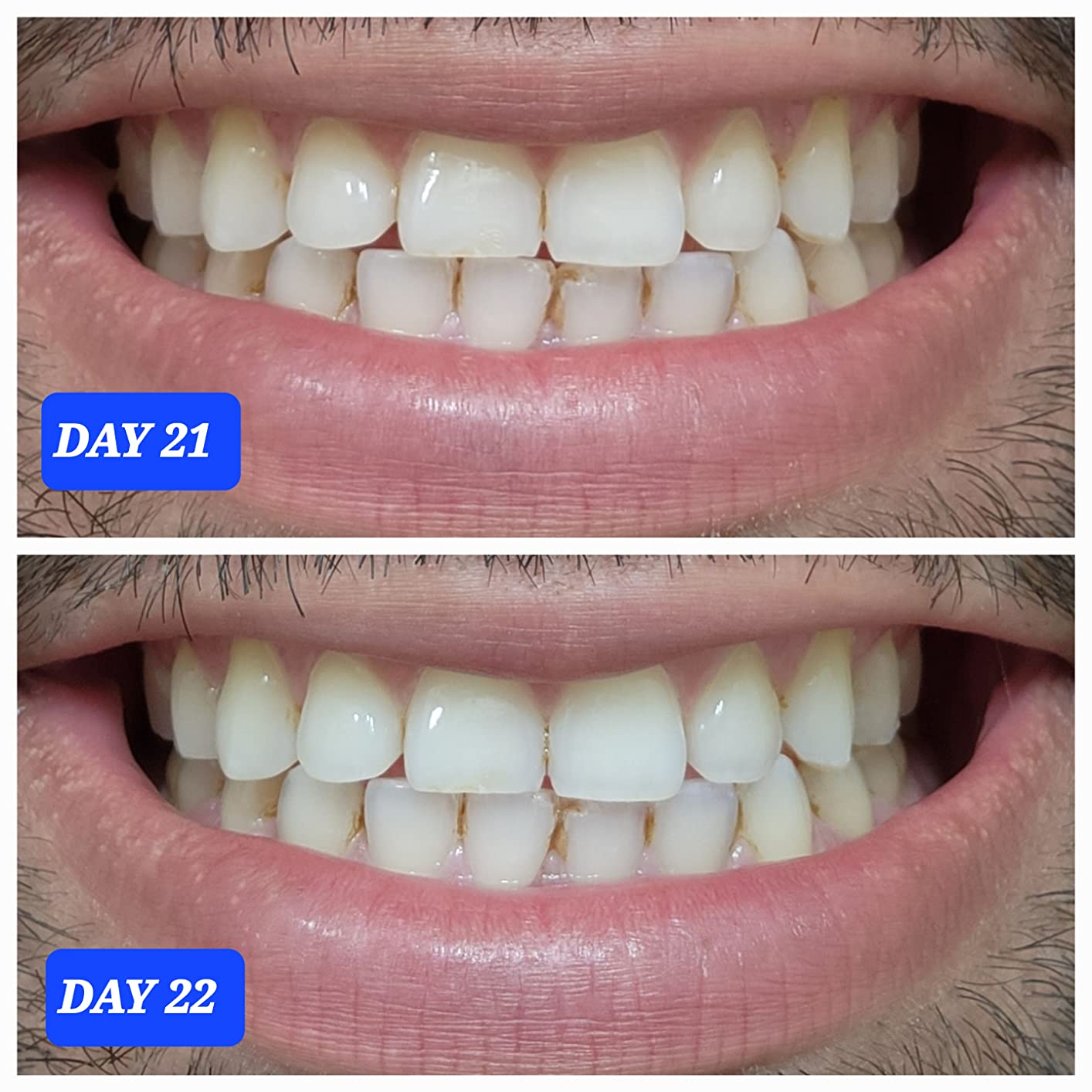 Crest 3D Whitestrips Professional Effects – Teeth Whitening Kit, 22 Treatments (20 + 2 Bonus), Each with 1 Upper/1Lower, 44 Strips – Crest 3DWhite Teeth Whitening Strips - Customer Photo 2