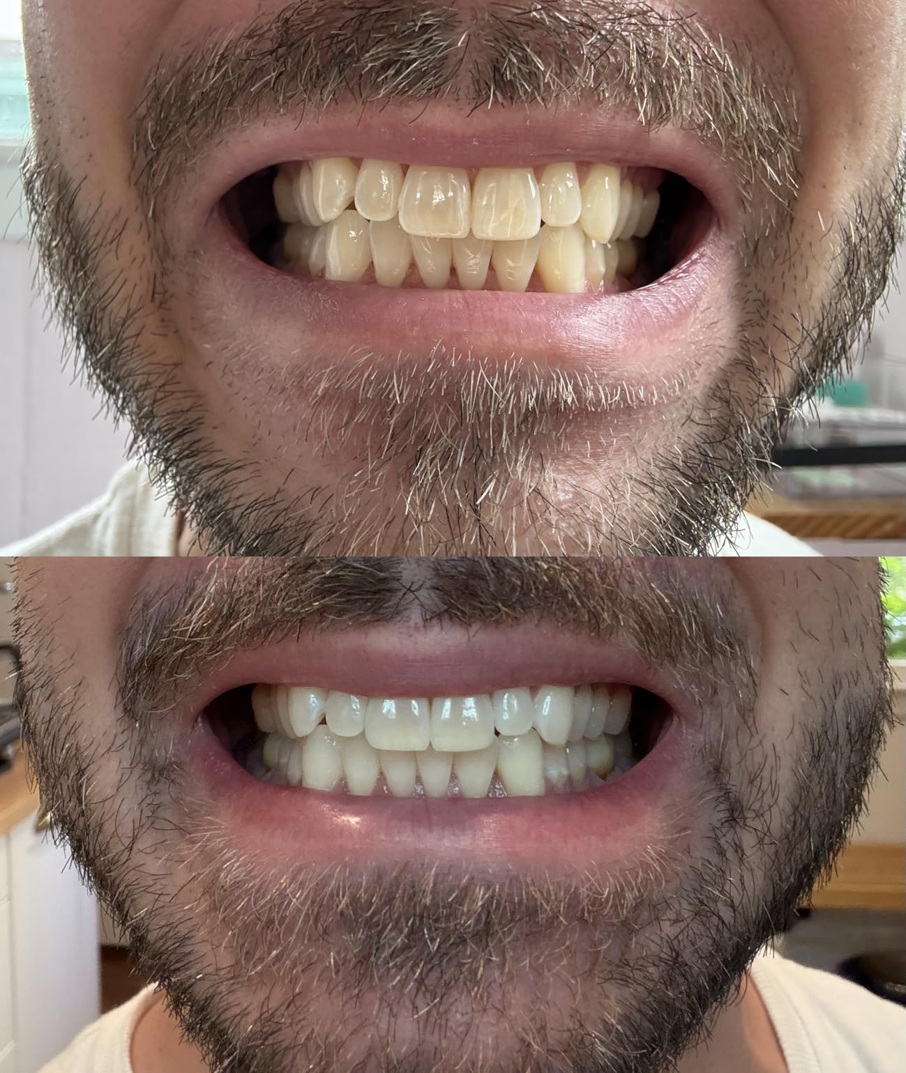 Opalescence Go 15- Prefilled Teeth Whitening Trays - 15% Hydrogen Peroxide - (10 Treatments) Made by Ultradent Products. Teeth Whitening Kit -Mint - 5194-1 - Customer Photo 1