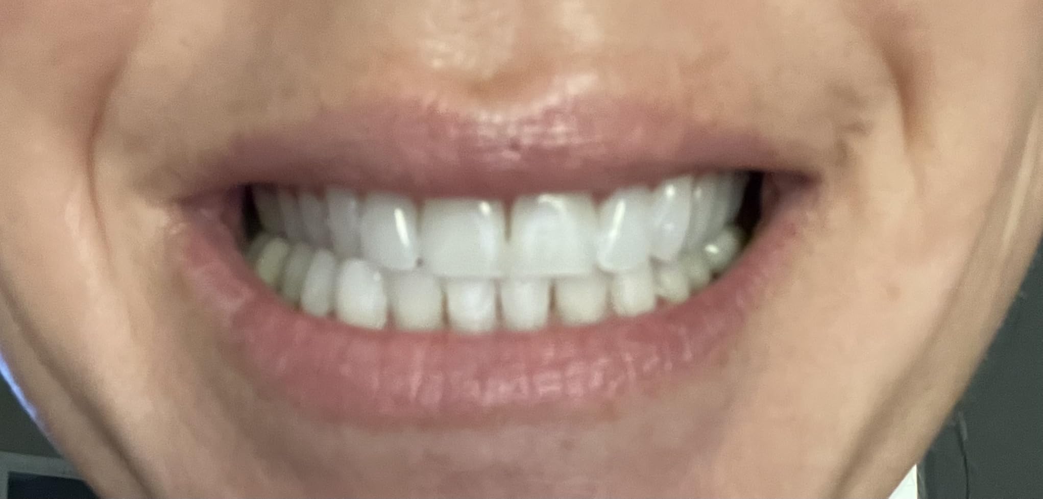 Opalescence Go 15- Prefilled Teeth Whitening Trays - 15% Hydrogen Peroxide - (10 Treatments) Made by Ultradent Products. Teeth Whitening Kit -Mint - 5194-1 - Customer Photo 2