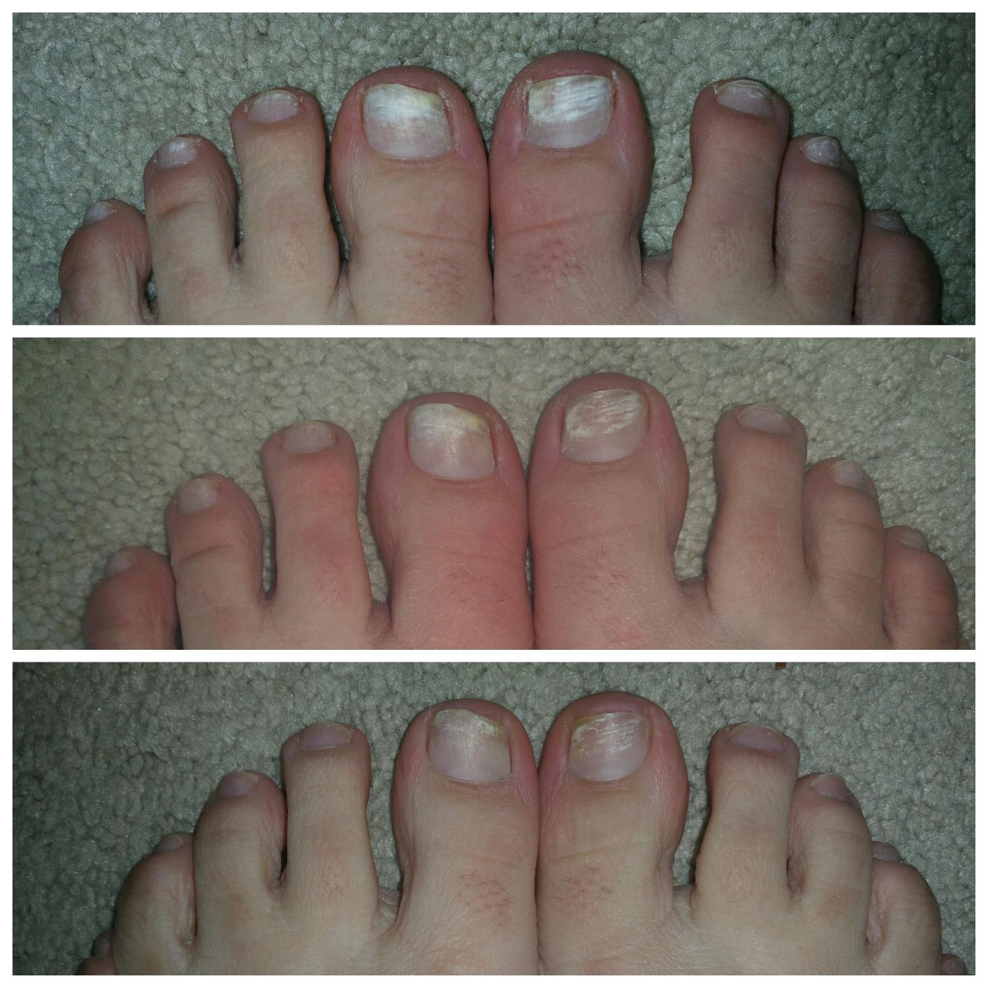 Probelle Natural Fungal Nail Oil, Nail Color Restoration, Clear Topical Solution .5 oz/ 15 ml - Customer Photo 1