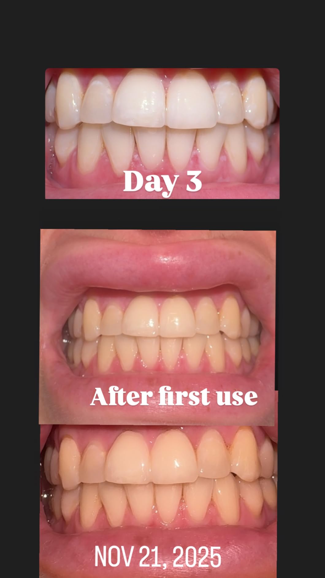 Auraglow Teeth Whitening Kit, LED Accelerator Light, 35% Carbamide Peroxide Teeth Whitening Gel, 20+ Whitening Treatments, Whitens up to 10 Shades in 7 Days - Customer Photo 1