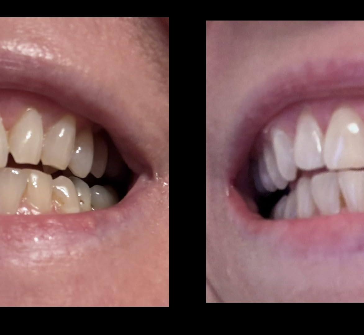 Lumineux Teeth Whitening Strips Kit - 9 Treatments - Peroxide Free - Enamel Safe for Whiter Teeth - Whitening Without The Sensitivity - Dentist Formulated - Sensitivity Free - Customer Photo 1