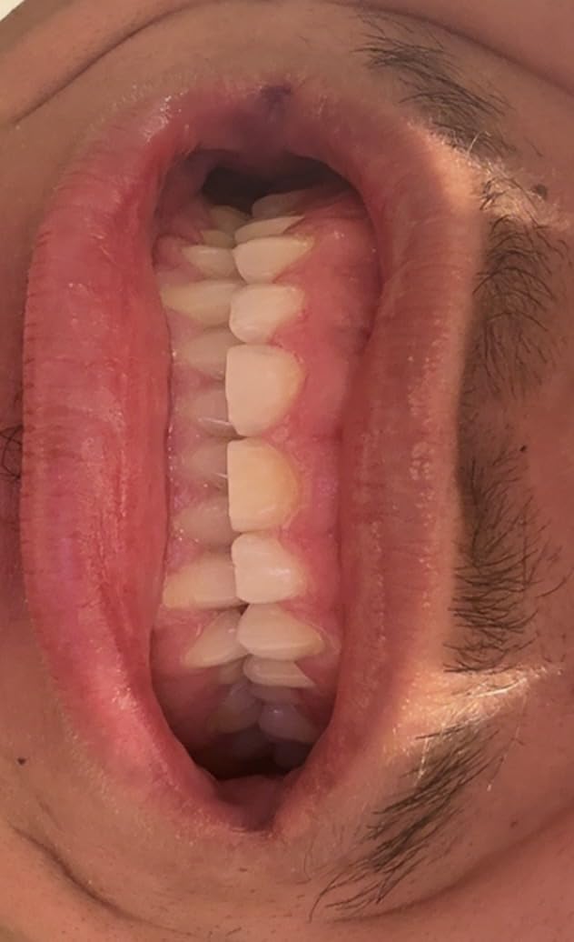 GuruNanda Teeth Whitening Strips - 7-Day Treatment with Non-Slip, Dry Strip Technology - Whitening Designed with Care for a Brighter Smile - Customer Photo 1