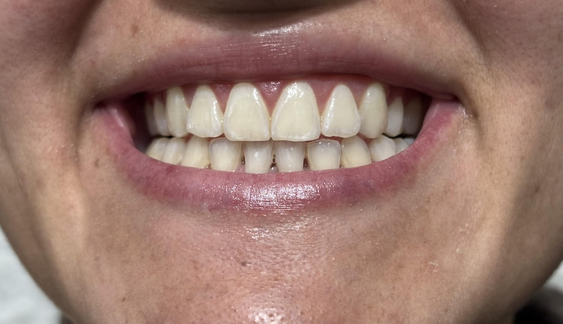 Crest 3D Whitestrips Sensitive At-Home Teeth Whitening Kit, 18 Treatments, Gently Removes 15 Years of Stains, Crest Whitestrips, Teeth Whitening Kit - Customer Photo 1