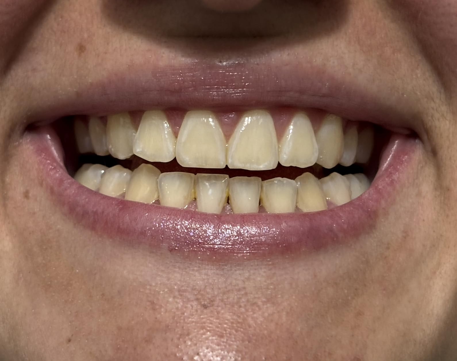 Crest 3D Whitestrips Sensitive At-Home Teeth Whitening Kit, 18 Treatments, Gently Removes 15 Years of Stains, Crest Whitestrips, Teeth Whitening Kit - Customer Photo 2