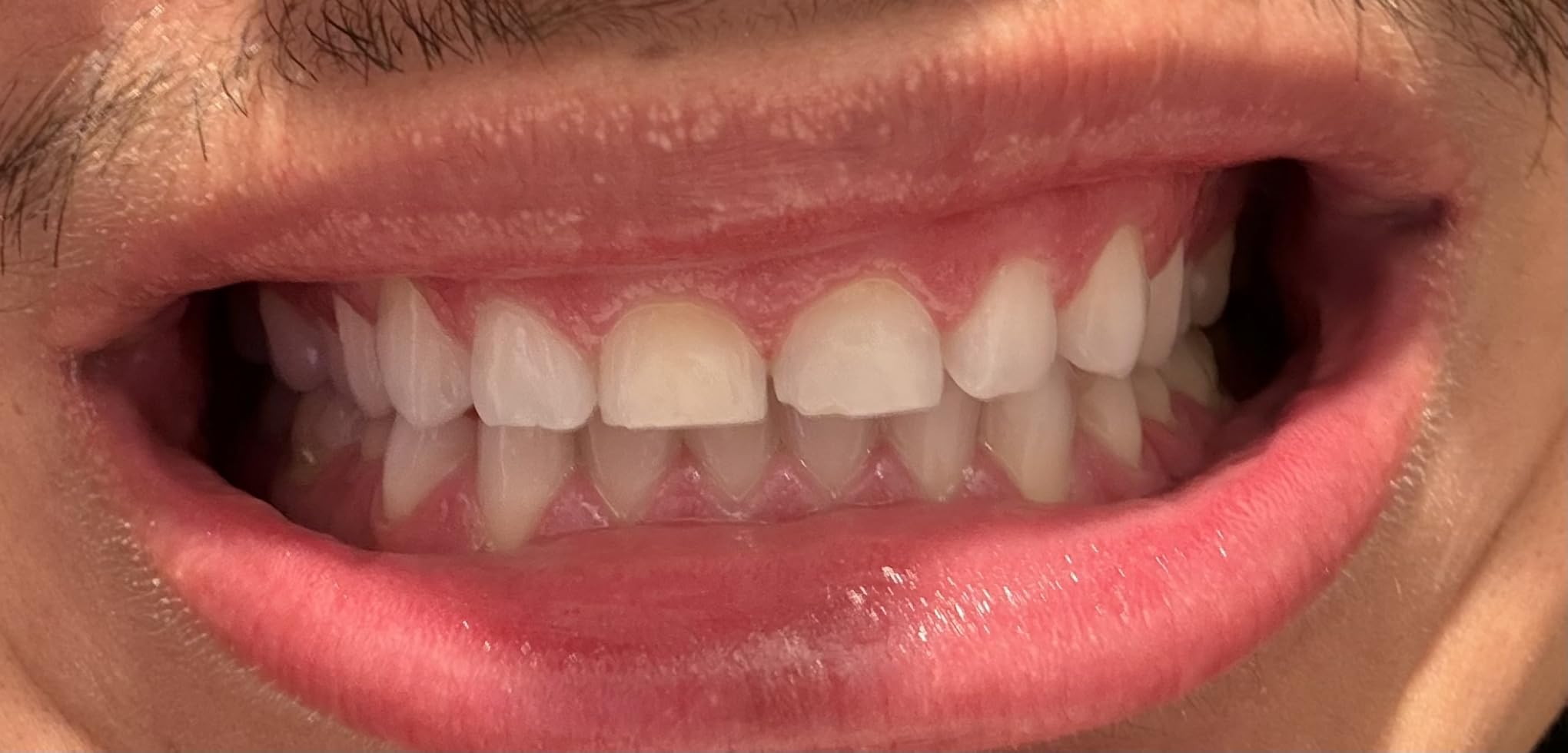 GuruNanda Teeth Whitening Strips - 16-Day Treatment with Non-Slip, Dry Strip Technology - Whitening Designed with Care for a Brighter Smile - Customer Photo 2