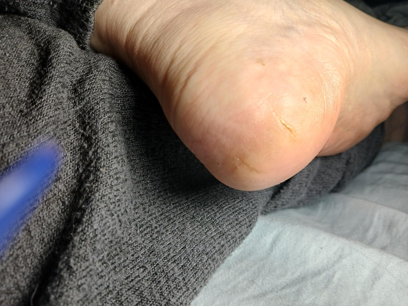 O'Keeffe's for Healthy Feet Foot Cream - 3.2 oz Jar - Guaranteed Relief for Extremely Cracked, Dry Feet customer photo 1