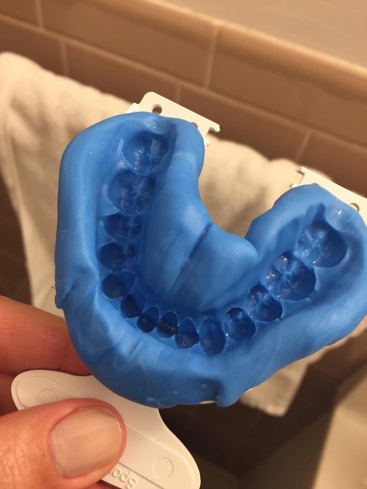 Custom Teeth Whitening Trays (Upper+Lower Set) customer photo 2