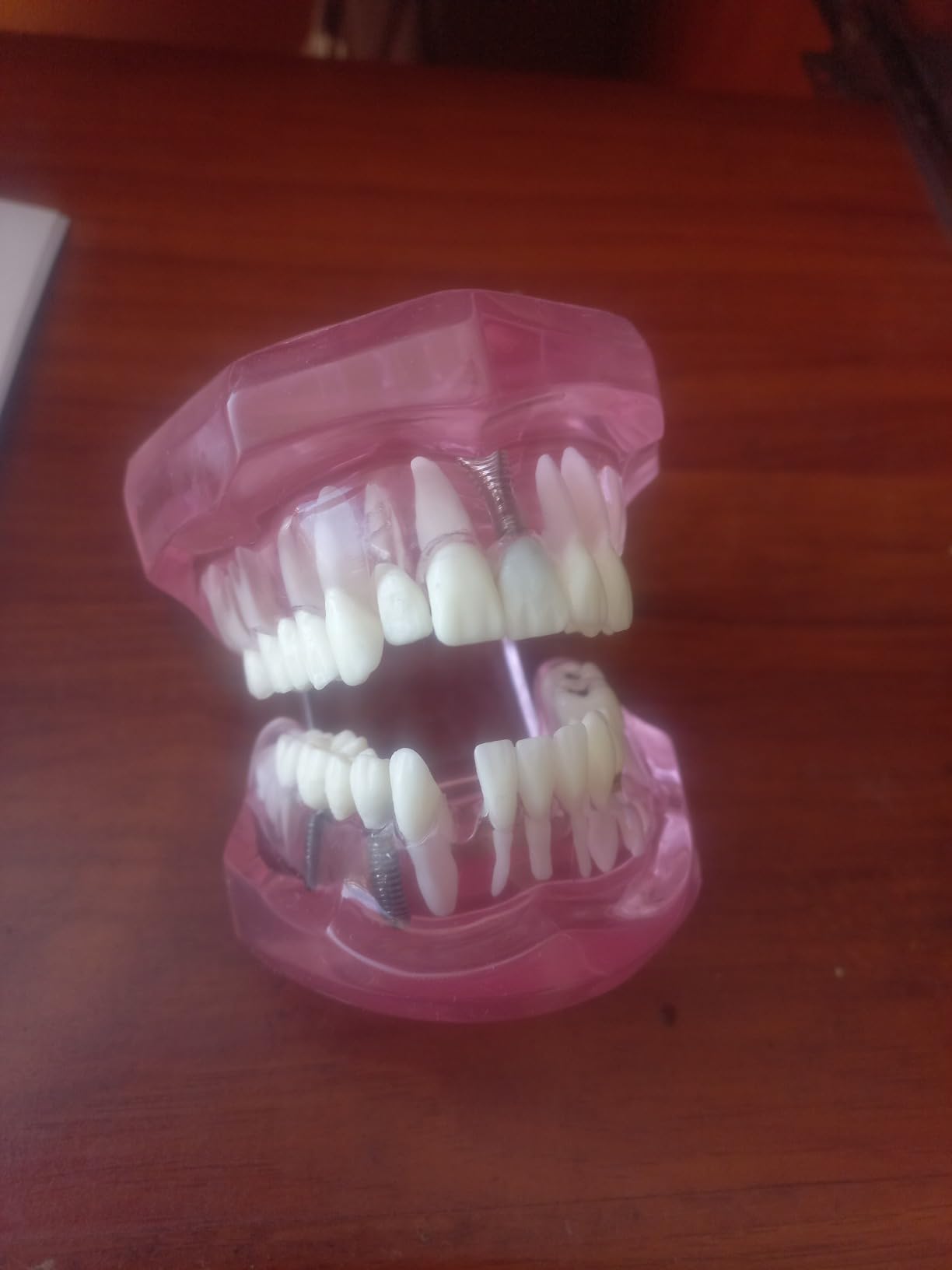 Teeth Model Teeth Typodonts Dental Implant Study Analysis Demonstration Teeth Model #2001 with Restoration Pink customer photo 1