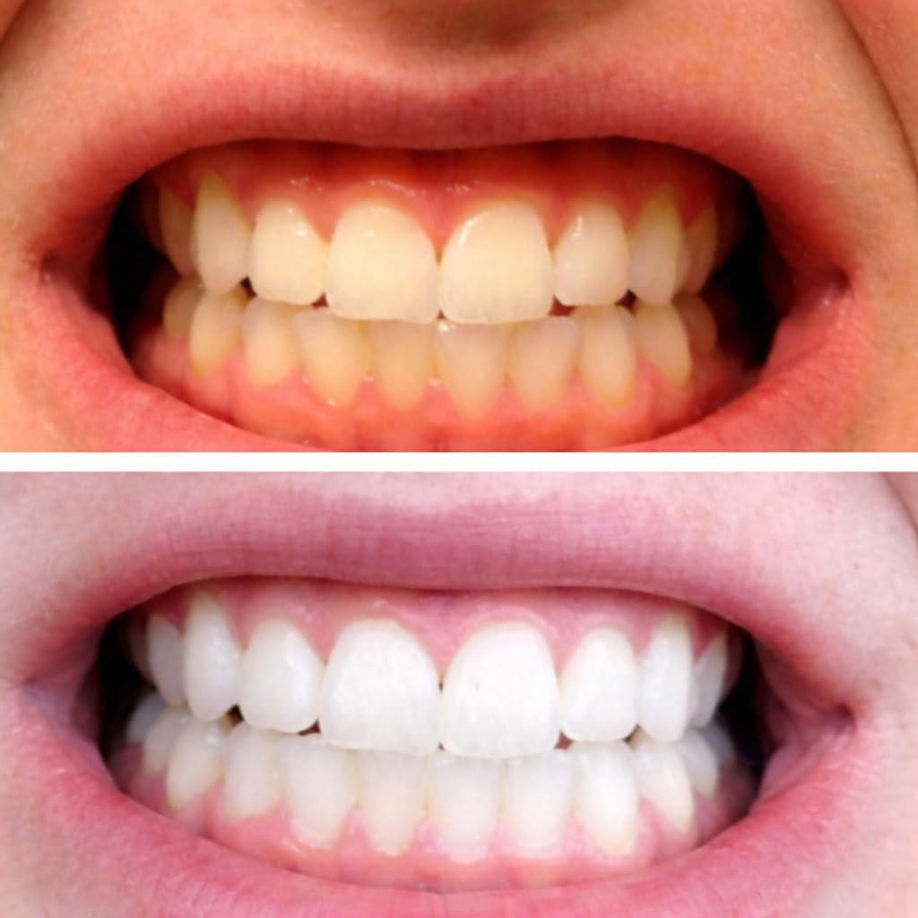 Moldable Teeth Whitening Trays for Gel Customizable Dental Mouth Guards - Compatible with Opalescence and All Gels - 4 Trays & 2 Storage Cases Thin, Trimmable, BPA-Free customer photo 1