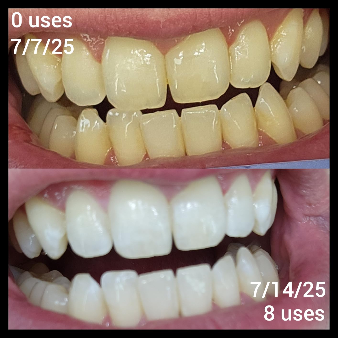 iSmile Teeth Whitening Kit - LED Light, 35% Carbamide Peroxide, 3 Gel Syringes, Remineralization Gel, and Tray customer photo 2