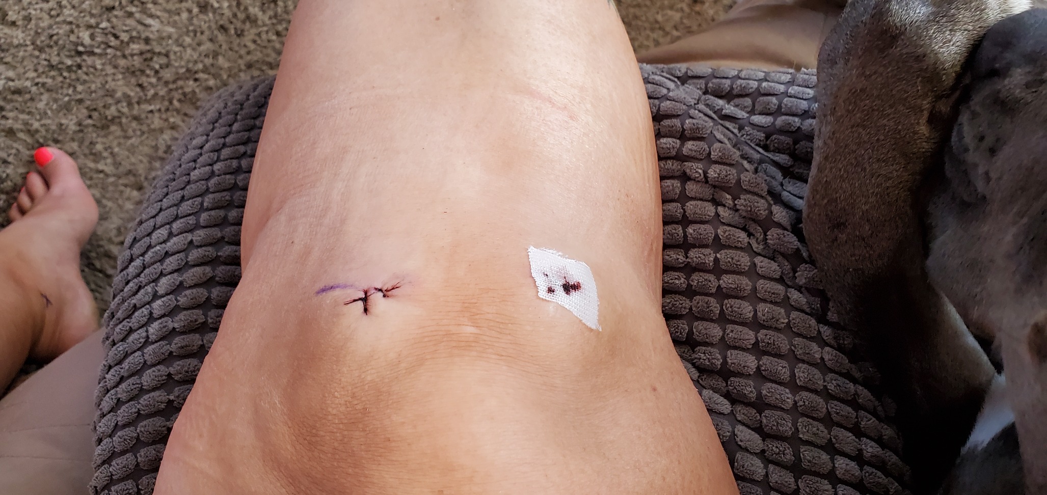 PhysioNatural Ice Pack for Knee Pain Relief, Reusable Gel Ice Wrap for Leg Injuries, Swelling, Knee Replacement Surgery, Cold Compress Therapy for Arthritis, Meniscus Tear and ACL customer photo 2