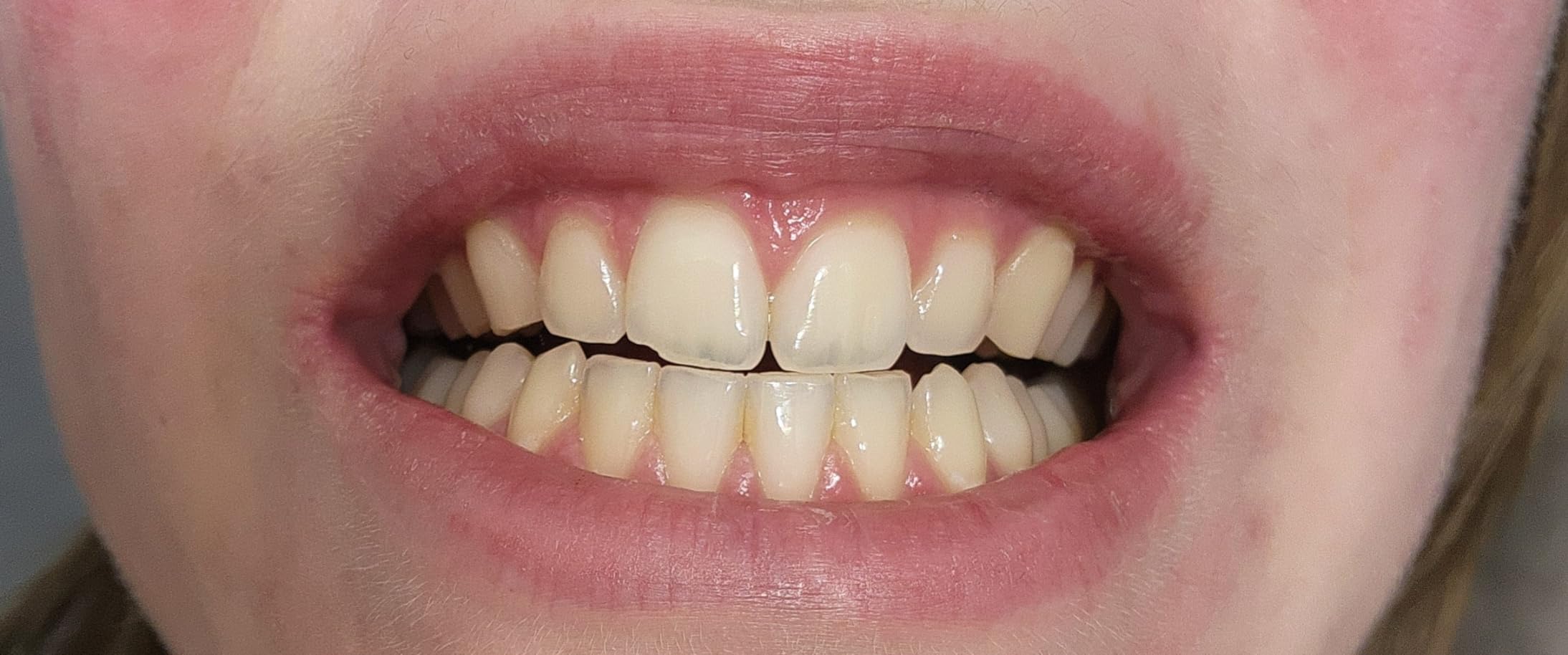 Colgate Optic White Overnight Teeth Whitening Pen, Teeth Stain Remover, Removes Years of Stains in Just 1 Week, Enamel Safe, Designed for No Tooth Sensitivity, 0.08 OZ customer photo 2