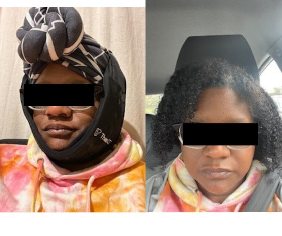 TheraICE Soft Wisdom Teeth Recovery Ice Pack Face Wrap. TMJ Pain Relief Product. Dental Oral Surgery Ice Pack. Jaw Chin Tonsillectomy Head Facial Jaw Bra Stretchable Cold Gel. No Hard Insert-1 Size customer photo 1