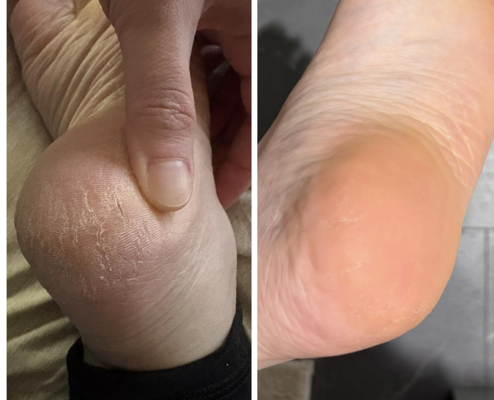 Dr. Scholl's Dry, Cracked Foot Repair Ultra-Hydrating Foot Cream Moisturizer, 3.5 oz, with 25% Urea customer photo 1