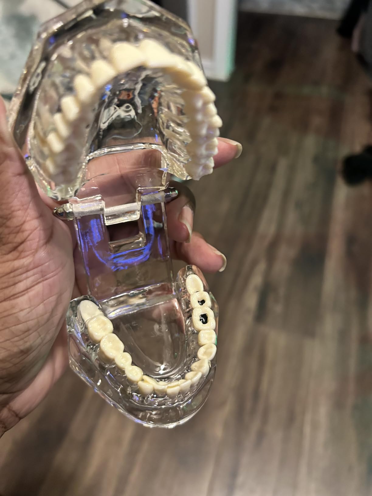 Ultrassist Transparent Disease Teeth Model with Dental Implant Bridge, Dental Model for Patient and Dental Student Education customer photo 2