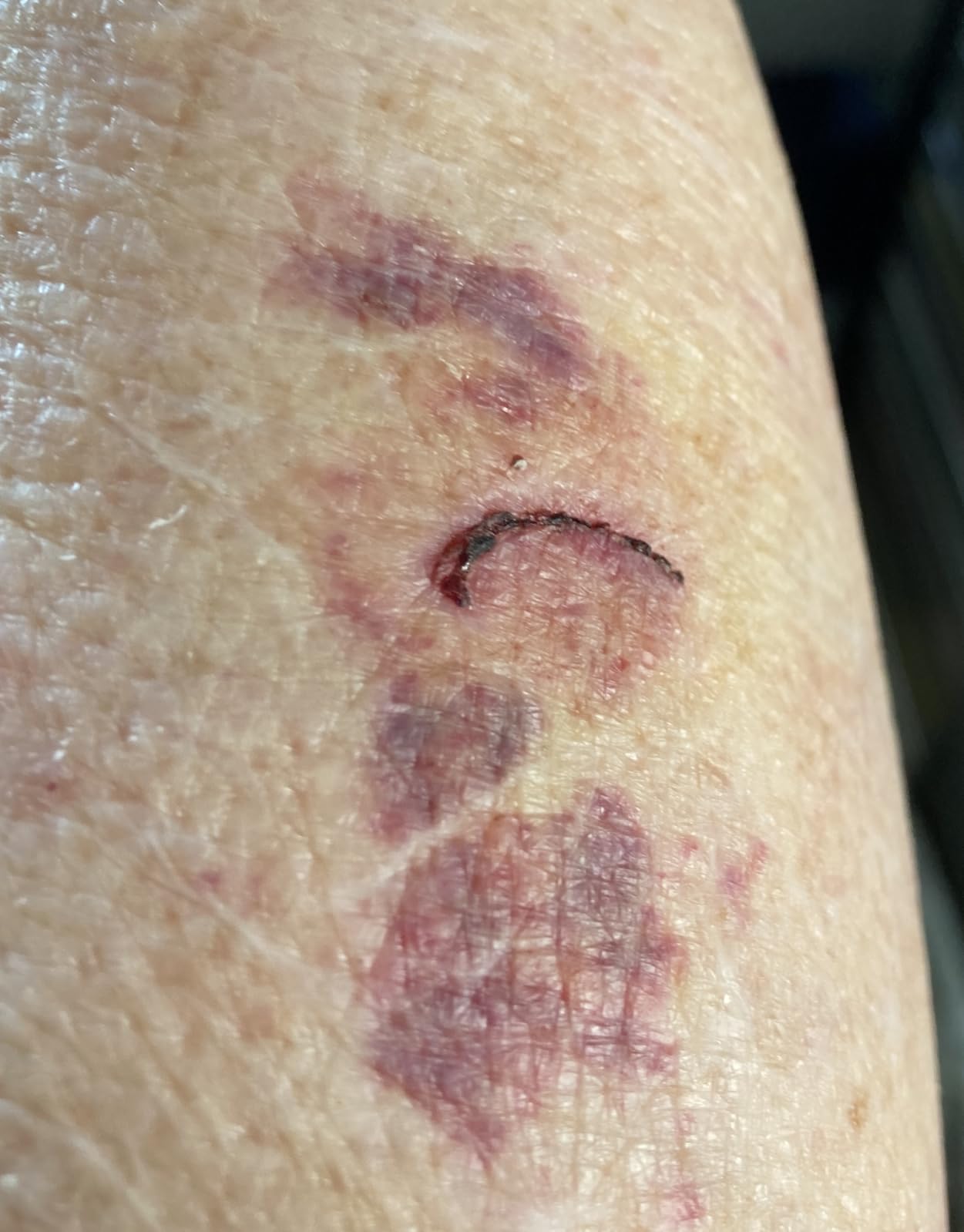 BleedStop First Aid Powder for Blood Clotting - 4 (15g) Pouches - Trauma Kit for Moderate to Severe Bleeding Wounds or Nosebleeds customer photo 1