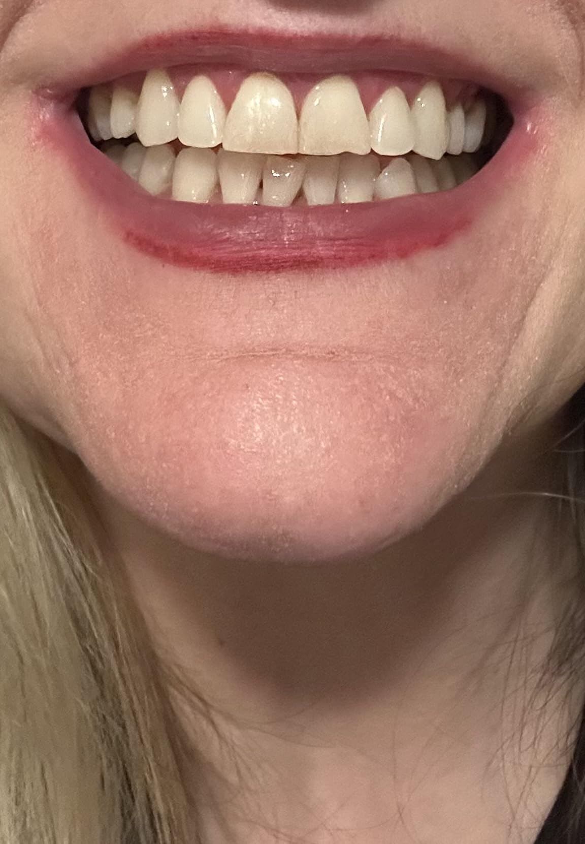 Teeth Whitening Pen 4+1(5 Pack), 70+ Treatments, Use Twice a Day Up to 1-6 Shade Whiter in 1-2 Weeks, 4 Whitening Pens plus 1 Desensitizing Pen, Effective, Painless and Enamel Safe Teeth Whitening Gel customer photo 2