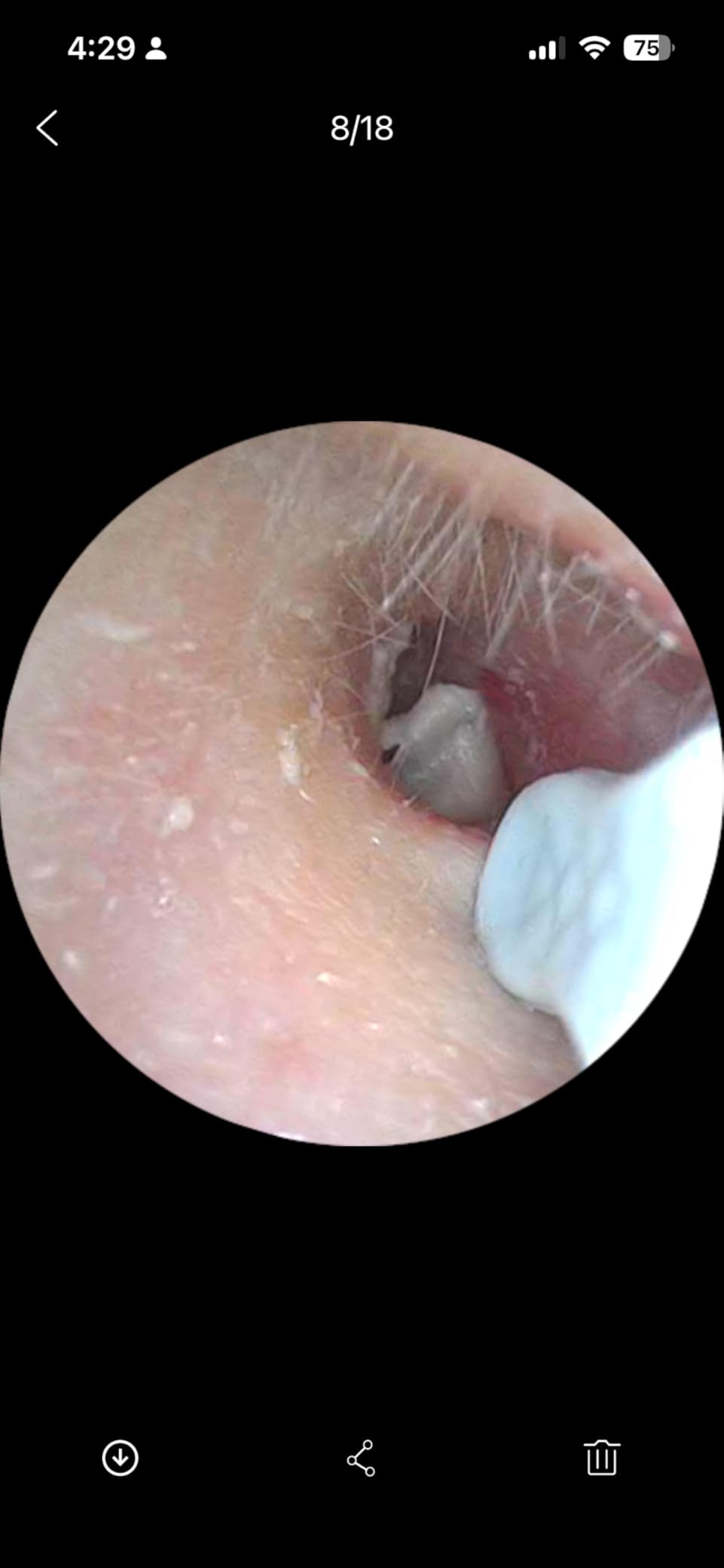 Loyker Ear Wax Removal, Ear Cleaner with Camera with 1080P, Otoscope with Light, Ear Wax Removal Kit with 6 Ear Pick, Ear Camera for iPhone, iPad, Android Phones (Blue) customer photo 1