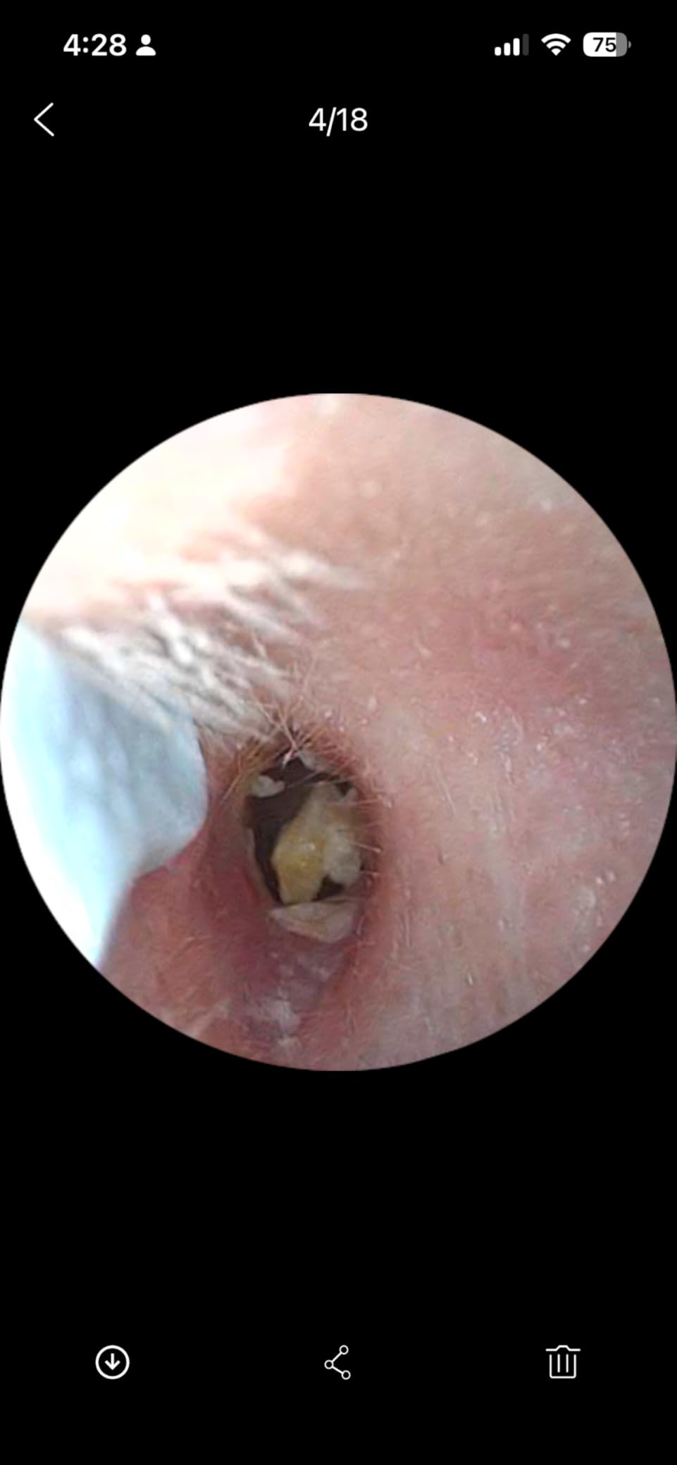 Loyker Ear Wax Removal, Ear Cleaner with Camera with 1080P, Otoscope with Light, Ear Wax Removal Kit with 6 Ear Pick, Ear Camera for iPhone, iPad, Android Phones (Blue) customer photo 2