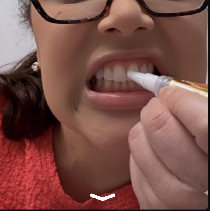 Auraglow Teeth Whitening Pen - Extra Strength 9% Hydrogen Peroxide, 40+ Treatments, No Sensitivity, Removes Coffee Wine Tea Stains, Whiten Teeth Fast, Enamel Safe, Made in USA, 4mL customer photo 2