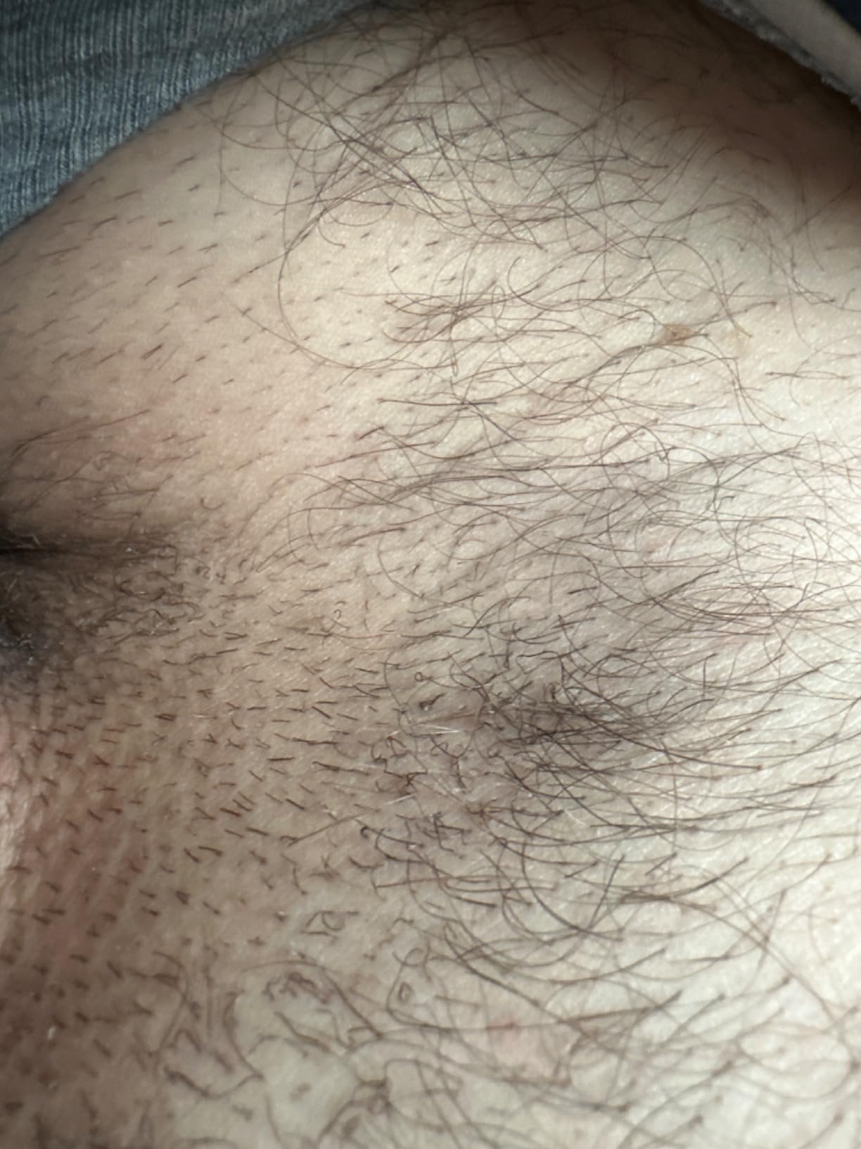 Braun Smart IPL, Skin i·Expert Pro 7, VOGUE's Best Hair Removal Device, IPL Hair Removal for Women and Men, Permanent Laser Hair Reduction At-Home, World's 1st Smart App, 3 Heads, IPL7243 customer photo 2