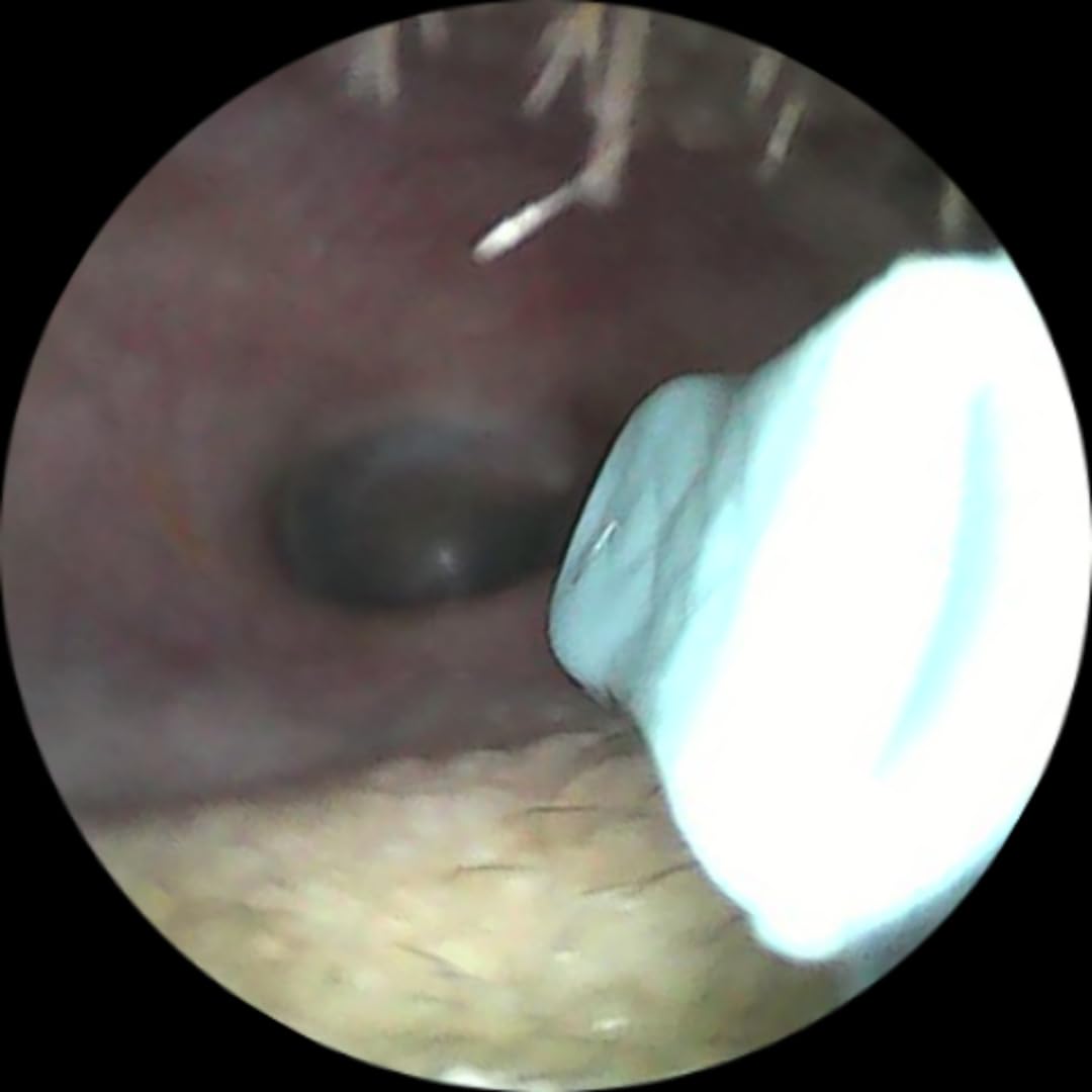 Ear Wax Removal, 3 in 1 Earwax Removal Kit, 1080P HD Ear Cleaner with Camera, FSA HSA Eligible, Otoscope with 7 Ear Spoon, Ear Cleaning 6 LED Lights 15 Ear Tips, Ear Camera for iOS & Android customer photo 1