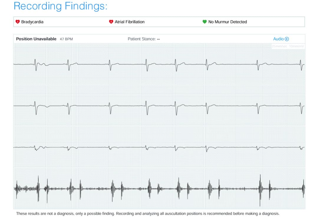 EKO CORE 500 Digital Stethoscope - 40x Amplification, Active Noise Cancellation, 3-Lead ECG, FDA-Cleared AI with EKO+, Full-Color Display, Reimbursement Eligible, Silver, COR501 customer photo 2