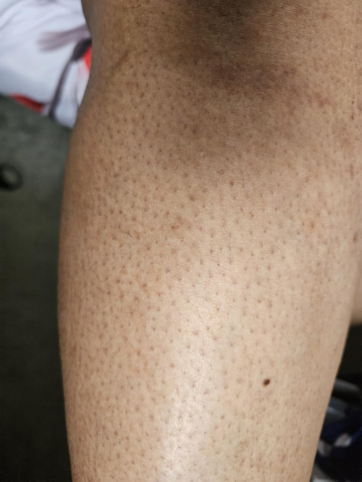 Ulike Laser Hair Removal Device Air 10 IPL Gift for Women and Men, Ice Cool and Permanent Hair Reduction for Nearly Painless, Dual Lights, Skin Sensor & USHR Mode Hair Removal in 10mins from Home customer photo 1