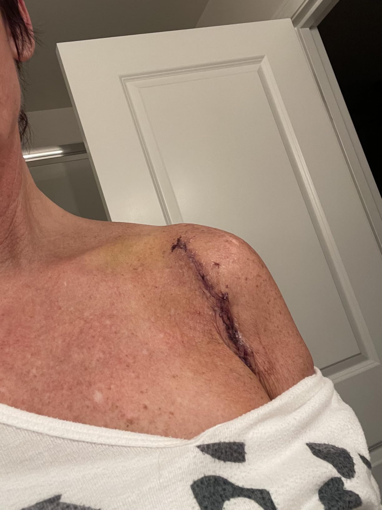 Ice Machine for Shoulder After Surgery, Shoulder Rotator Cuff Cold Therapy Machine Compression Pad Cryotherapy Machine for Post-Surgery Care, Ice Therapy System for Knee, Elbow, Joint (6-Quart) customer photo 1