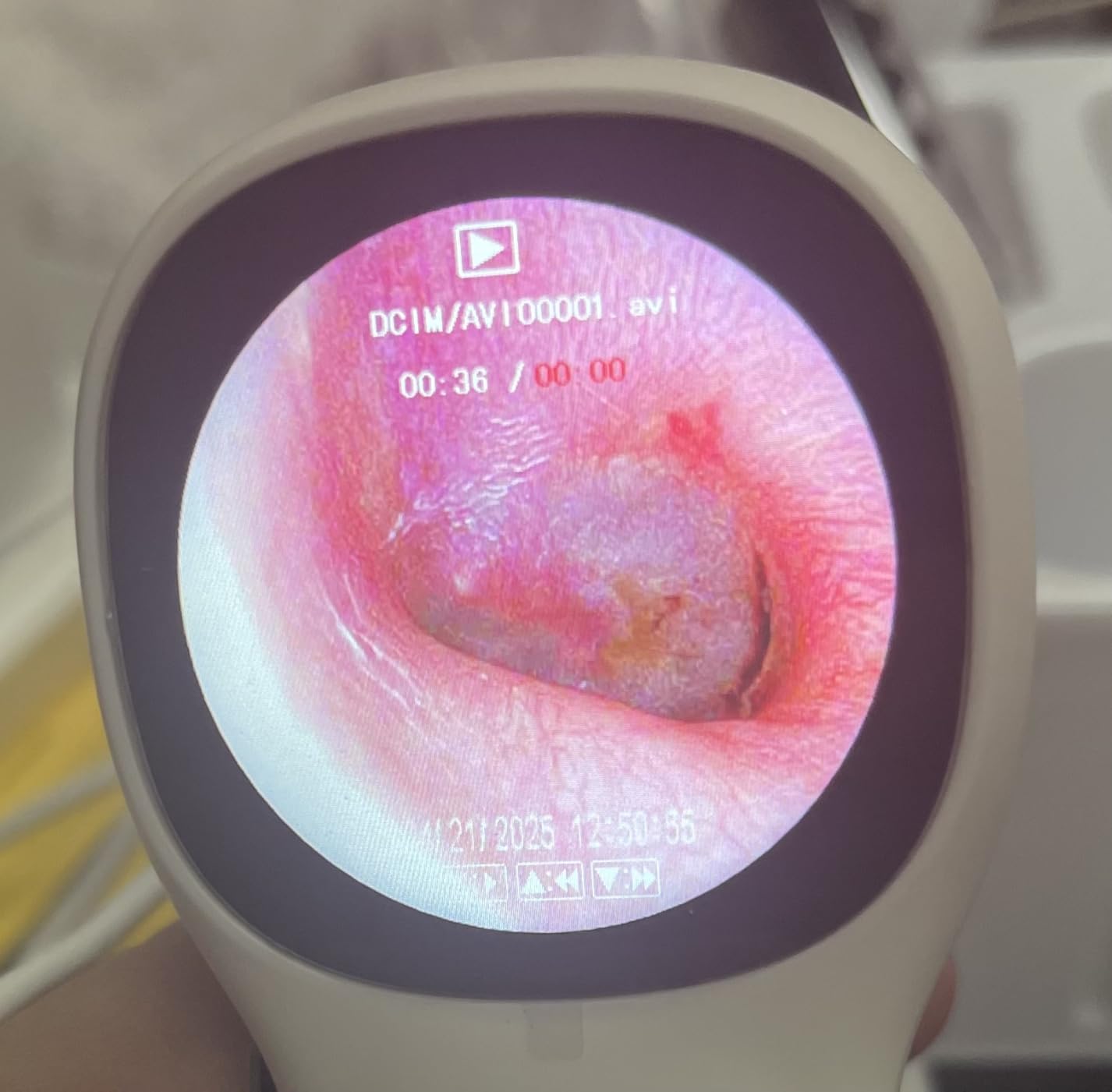 ScopeAround Digital Otoscope w/Built-in Screen, Manual-Focus Digital Otoscope with Light for Home Use, No App Needed, Easy Viewing for Everyday Ear Checks, Otoscope Camera, White customer photo 2