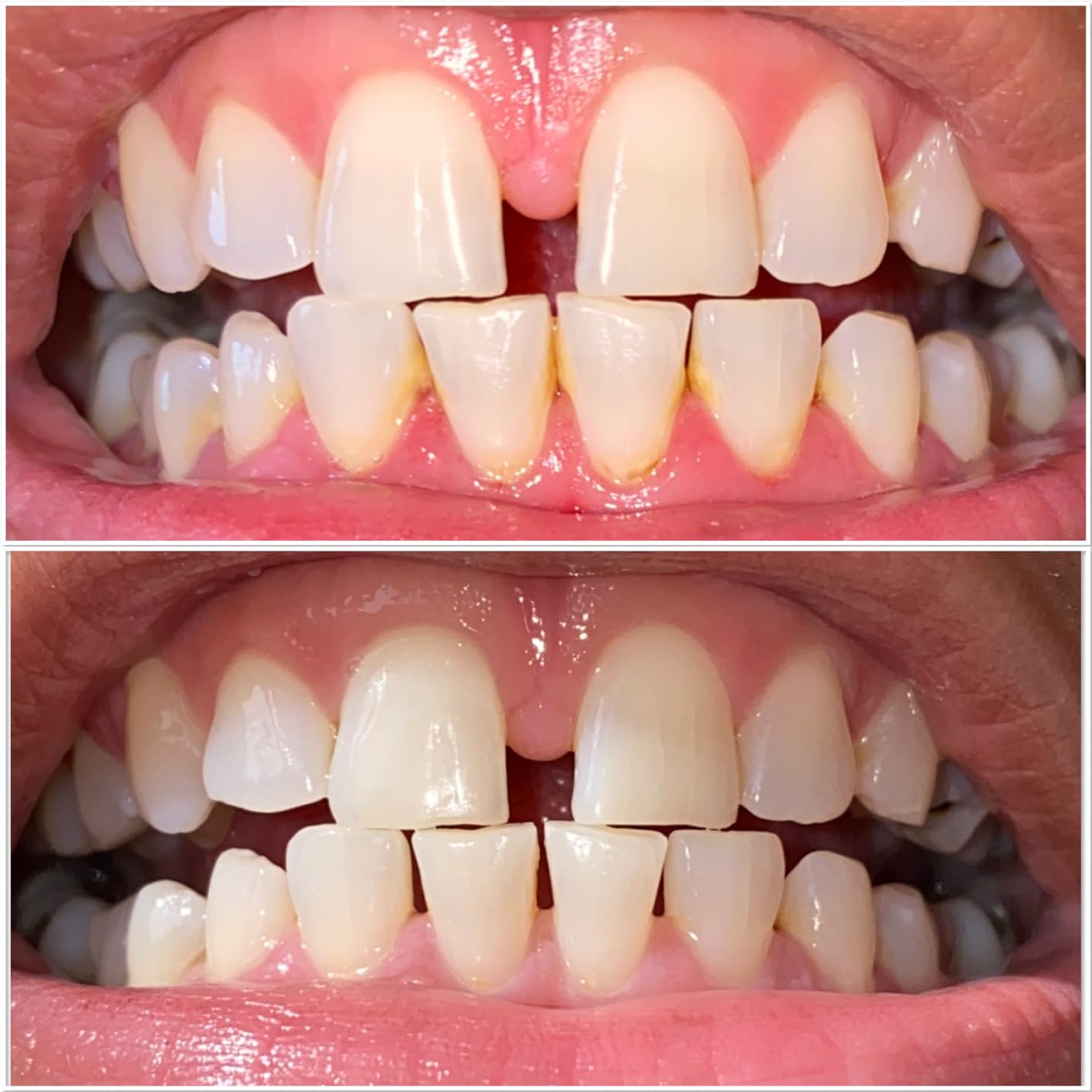 Plaque Remover for Teeth - Tartar Remover for Teeth, Dental Calculus Remover Teeth Cleaning Kit 4 Speed Modes with 4 Replaceable Heads, IPX6 Waterproof with LED Light customer photo 1