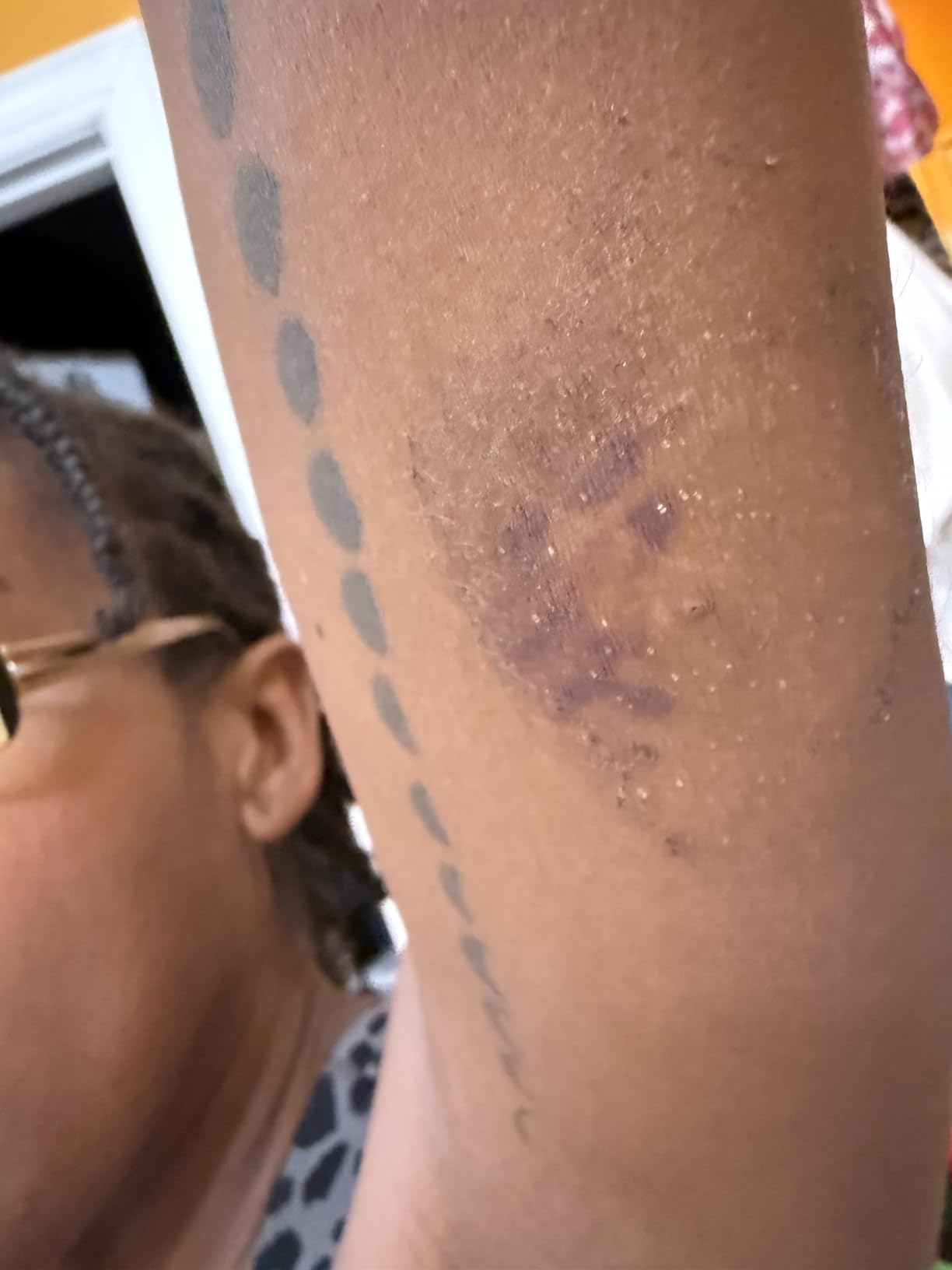 Stelo Glucose Biosensor & App by Dexcom - A Leader in Continuous Glucose Monitoring (CGM). 24/7 Tracking & Personalized Insights to Reveal Patterns. 2-Pack (Up to 15 Days Each). iOS & Android. customer photo 2