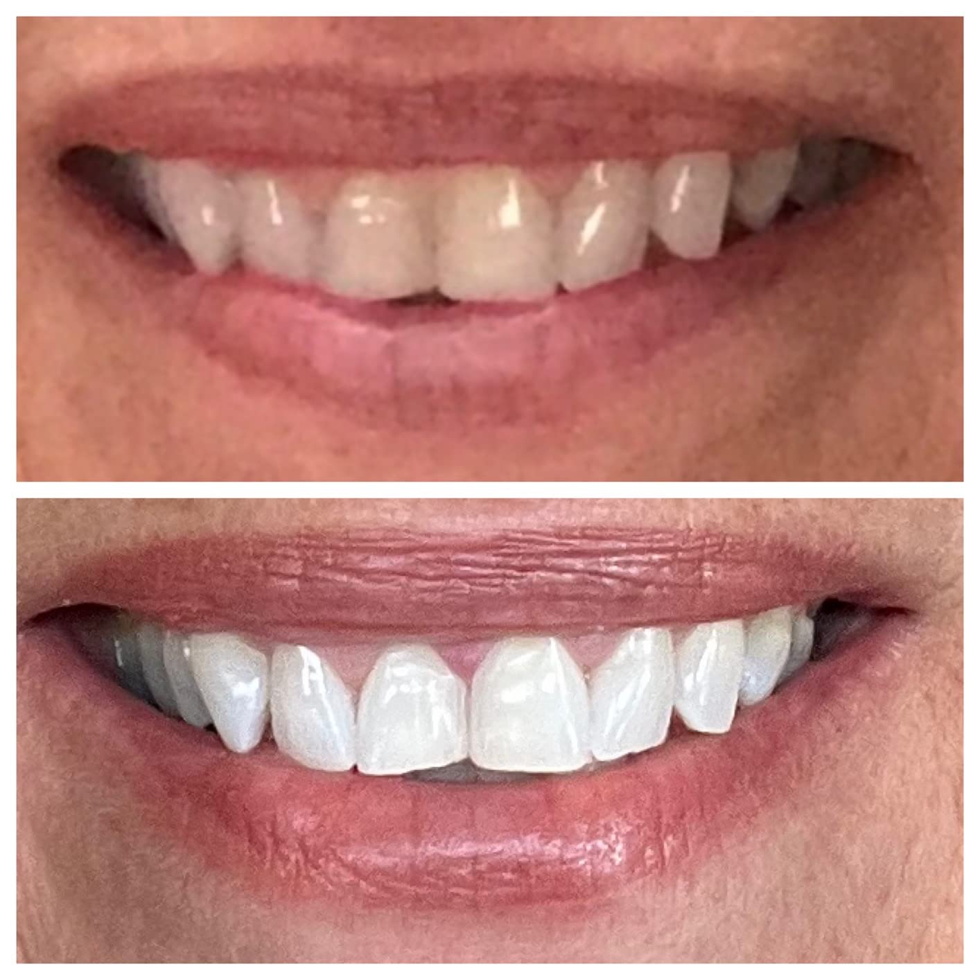 Teeth Whitening Pen Gel Kit: 35% Carbamide Peroxide Gel for Stain Removal - No Sensitivity with Remineralizing Pen for a Brighter Whiter Smile Mint (5 Pack) customer photo 1