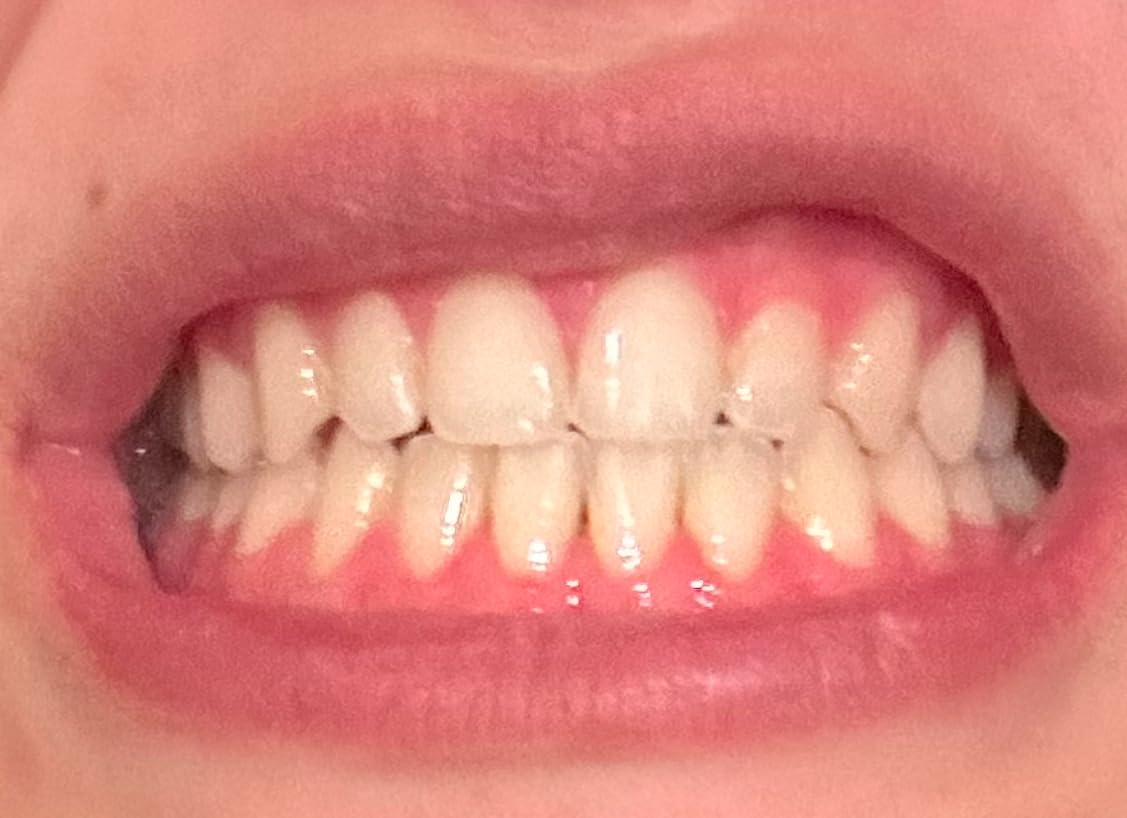 GuruNanda Professional Teeth Whitening Wireless Kit with LED Light and Whitening Pen, 40 Treatments customer photo 1