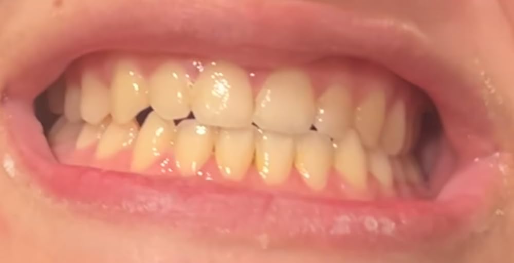 GuruNanda Professional Teeth Whitening Wireless Kit with LED Light and Whitening Pen, 40 Treatments customer photo 2