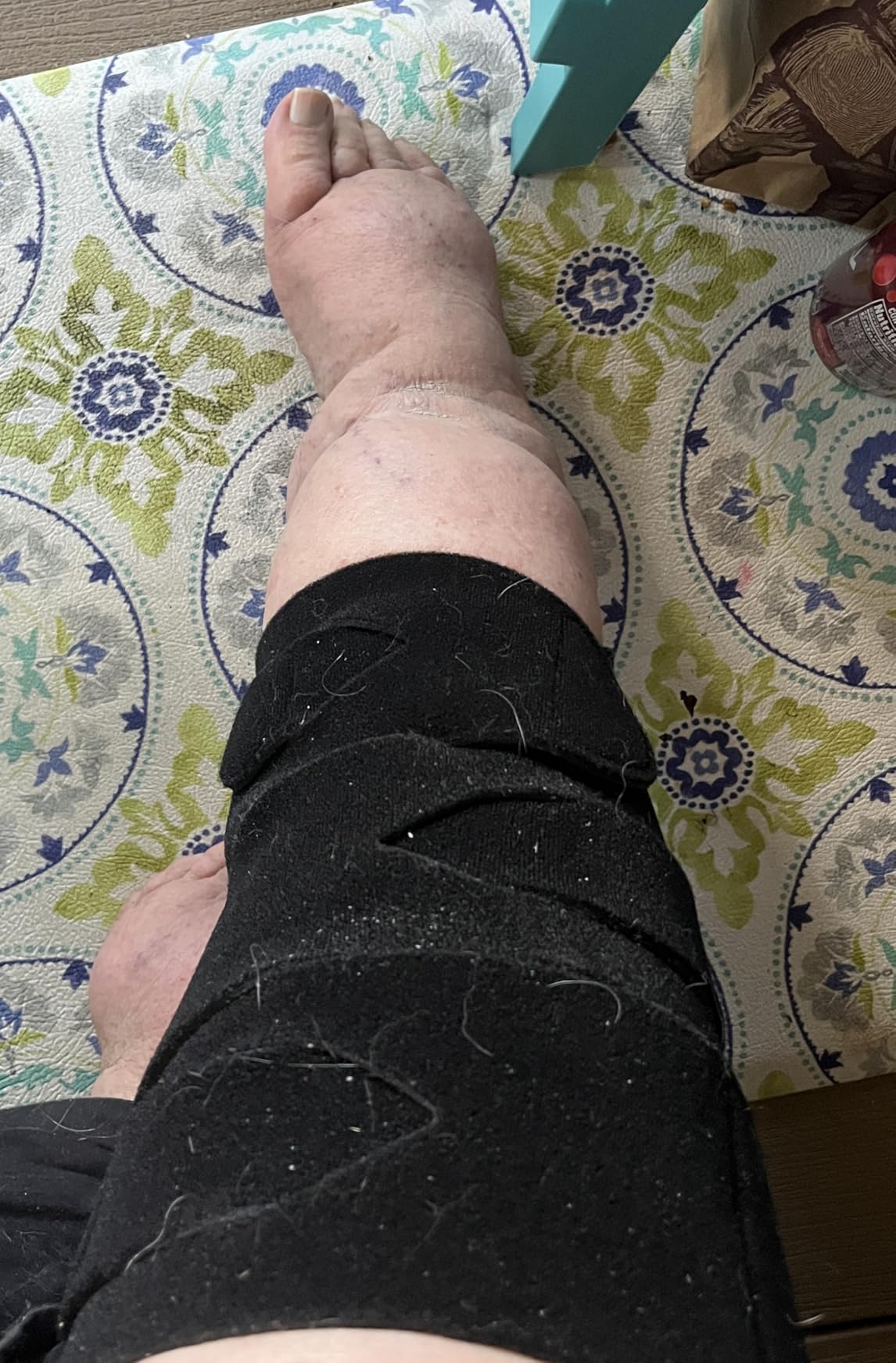 iDonua Calf Lymphedema Compression Wrap Adjustable For Big Swollen Lower Leg - with 6 Cross Straps customer photo 1