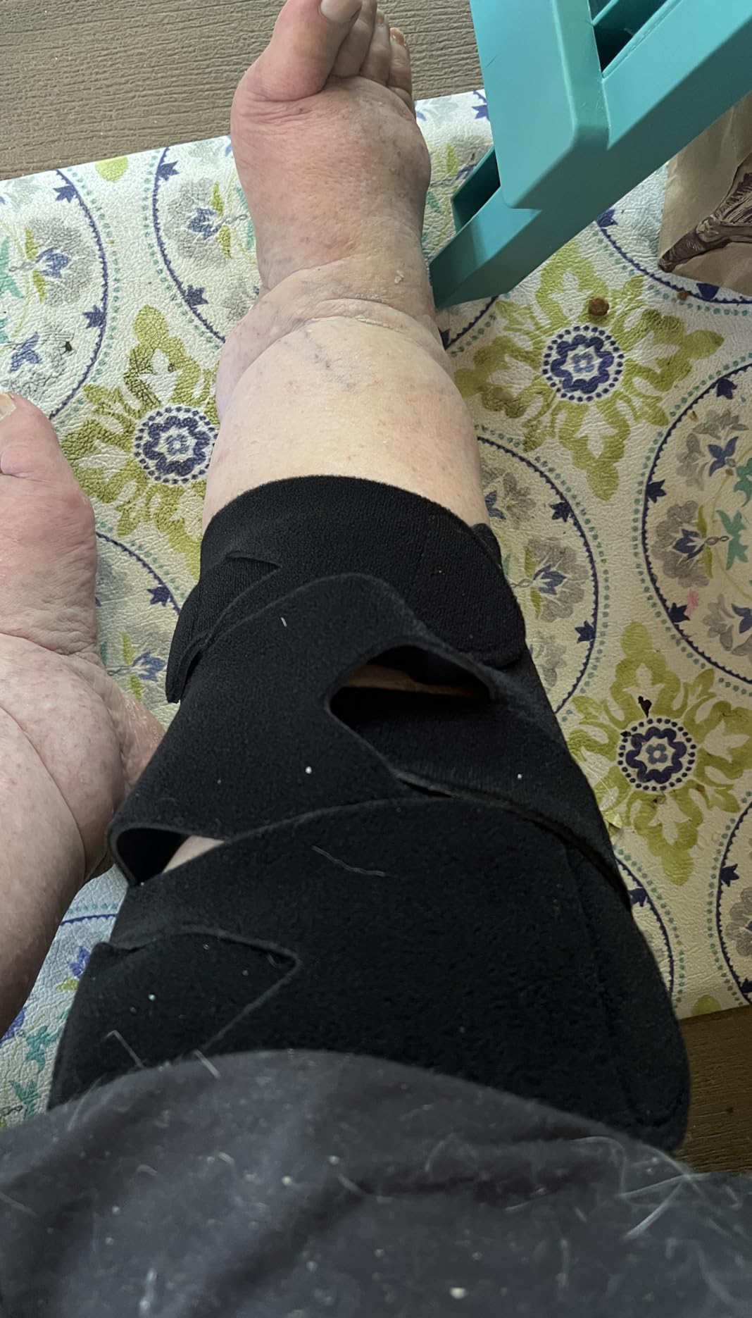 iDonua Calf Lymphedema Compression Wrap Adjustable For Big Swollen Lower Leg - with 6 Cross Straps customer photo 2