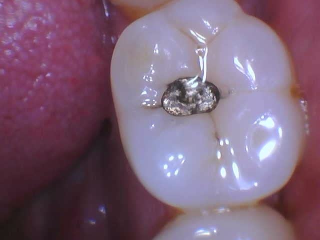 ProDENT Intraoral Camera PD740, Capture Button Driver to Work with Eaglesoft, Dexis, Apeteryx, Carestream, Tigerview, customer photo 2