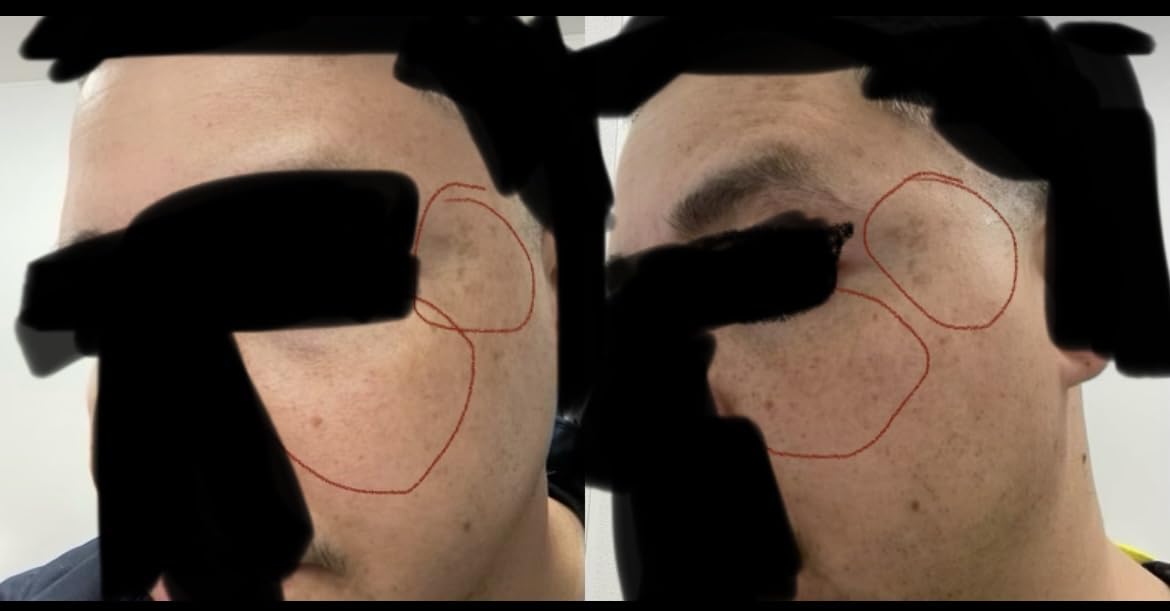 MLAY Professional RF Beauty Machine, Radio Frequency Face Machine with 2 Probes, at Home Radio Frequency Skin Tightening for Lifting, Wrinkle Reducing, Anti Aging - Salon Effects(Gel Included) customer photo 1