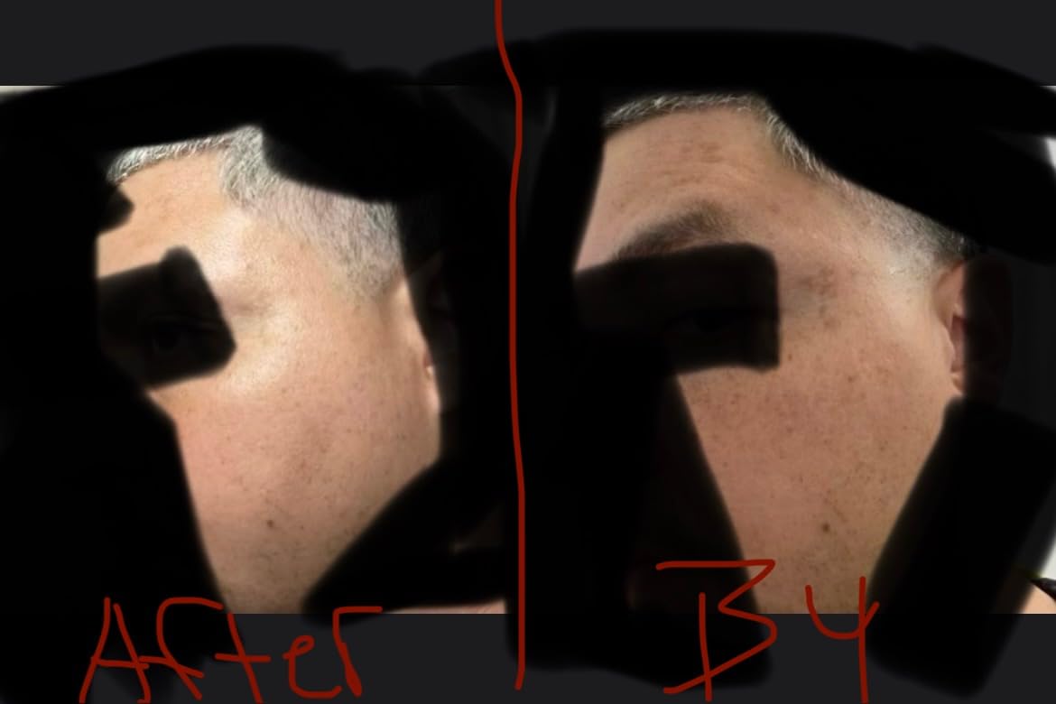 MLAY Professional RF Beauty Machine, Radio Frequency Face Machine with 2 Probes, at Home Radio Frequency Skin Tightening for Lifting, Wrinkle Reducing, Anti Aging - Salon Effects(Gel Included) customer photo 2