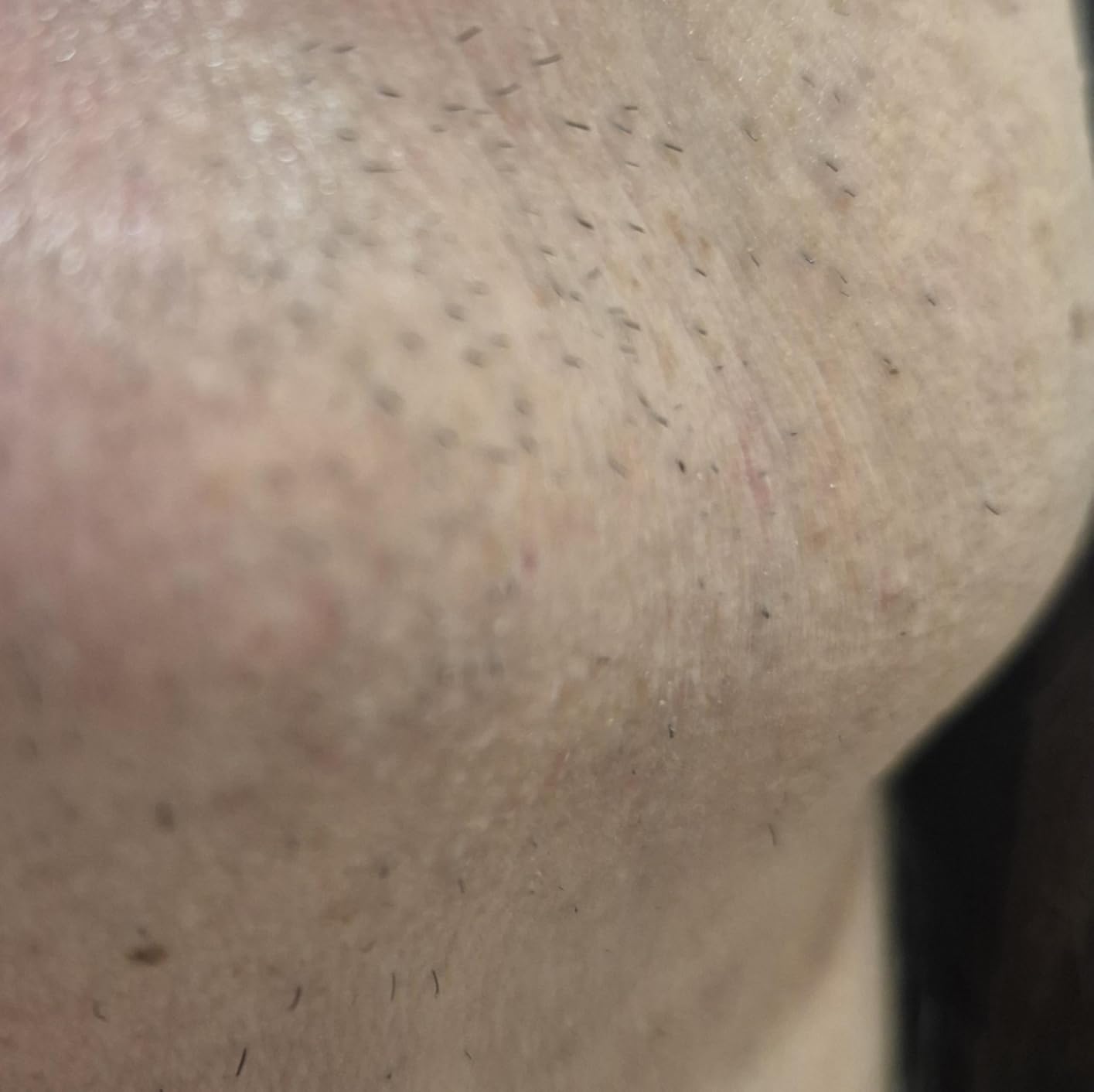 Braun Smart IPL, Skin i·Expert Pro 7, VOGUE's Best Hair Removal Device, IPL Hair Removal for Women and Men, Permanent Laser Hair Reduction At-Home, World's 1st Smart App, 4 Heads, IPL7387 customer photo 2