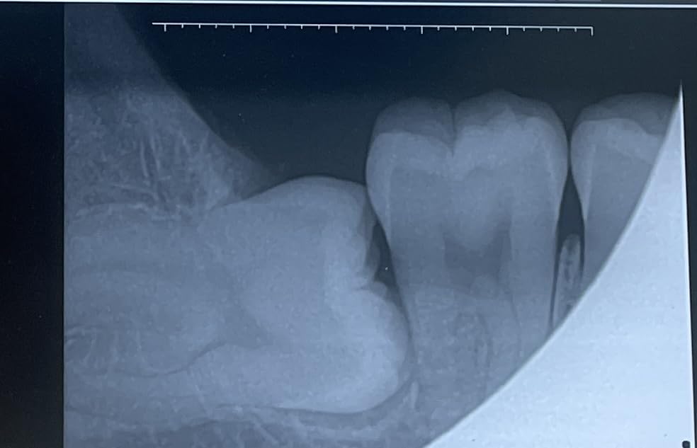 Dental X-Ray Sensor Veterinary Radiovisograph HD Digital Intraoral Imaging System Portable X Ray Digital Sensor (0.8 (21x21mm)) customer photo 1