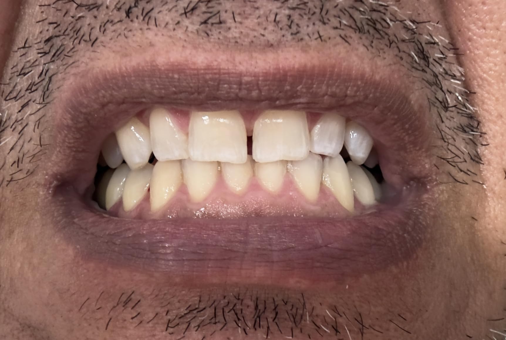 Crest 3D Whitestrips Glamorous White Teeth Whitening Strip Kit, 16 Treatments (32 Strips) customer photo 2