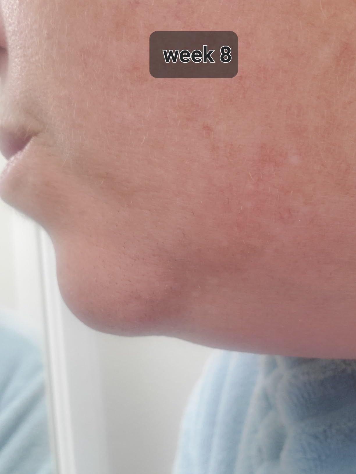 SmoothSkin Pure Fit IPL Hair Removal Device - At-Home Laser Hair Removal for Women & Men, Visible Results in 2 Weeks, Includes Precision Head, Safe for Face & Body, Long-Lasting Hair Reduction customer photo 2