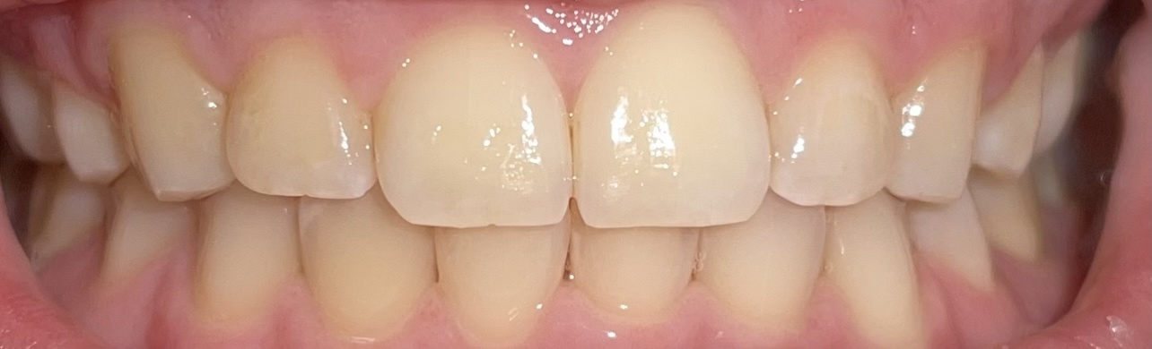 Crest 3D Whitestrips Express Whitening with Light, Whitestrips 3D White, Teeth Whitening Strip Kit, 20 Strips (10 Count Pack), Crest Teeth Whitening Strips, Teeth Whitening Kit customer photo 1