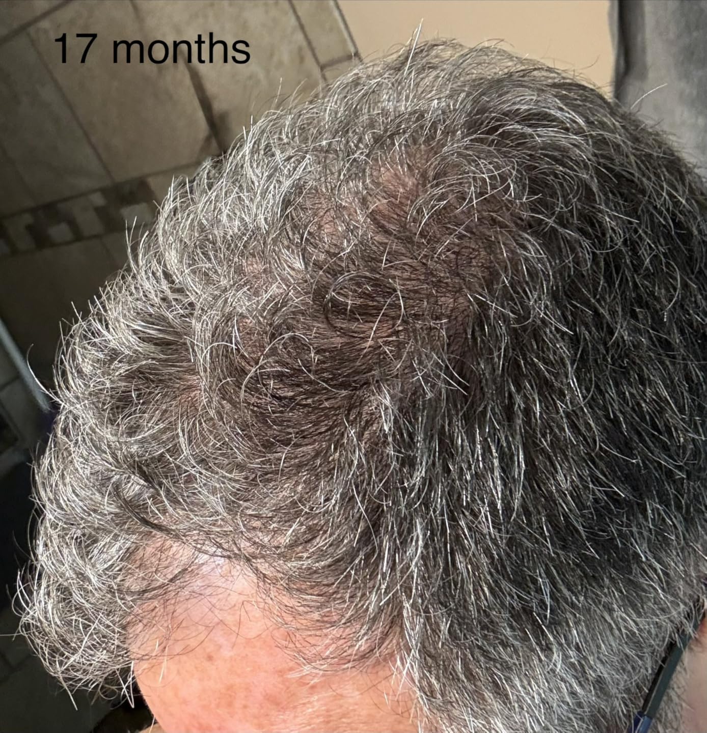 iRestore Professional Laser Red Light Therapy for Hair Growth System - FDA Cleared Hair Loss, Hair Thinning & Alopecia Treatment for Men & Women - 282 Lasers & LEDs customer photo 2