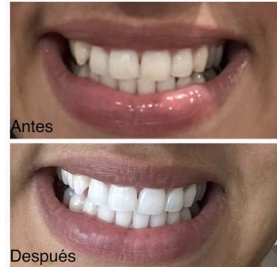 Auraglow Teeth Whitening Kit with LED Light & Extra Strength 44% Carbamide Peroxide Teeth Whitening Gel Refill, 30+ Treatments, Whiten Up to 10 Shades customer photo 1