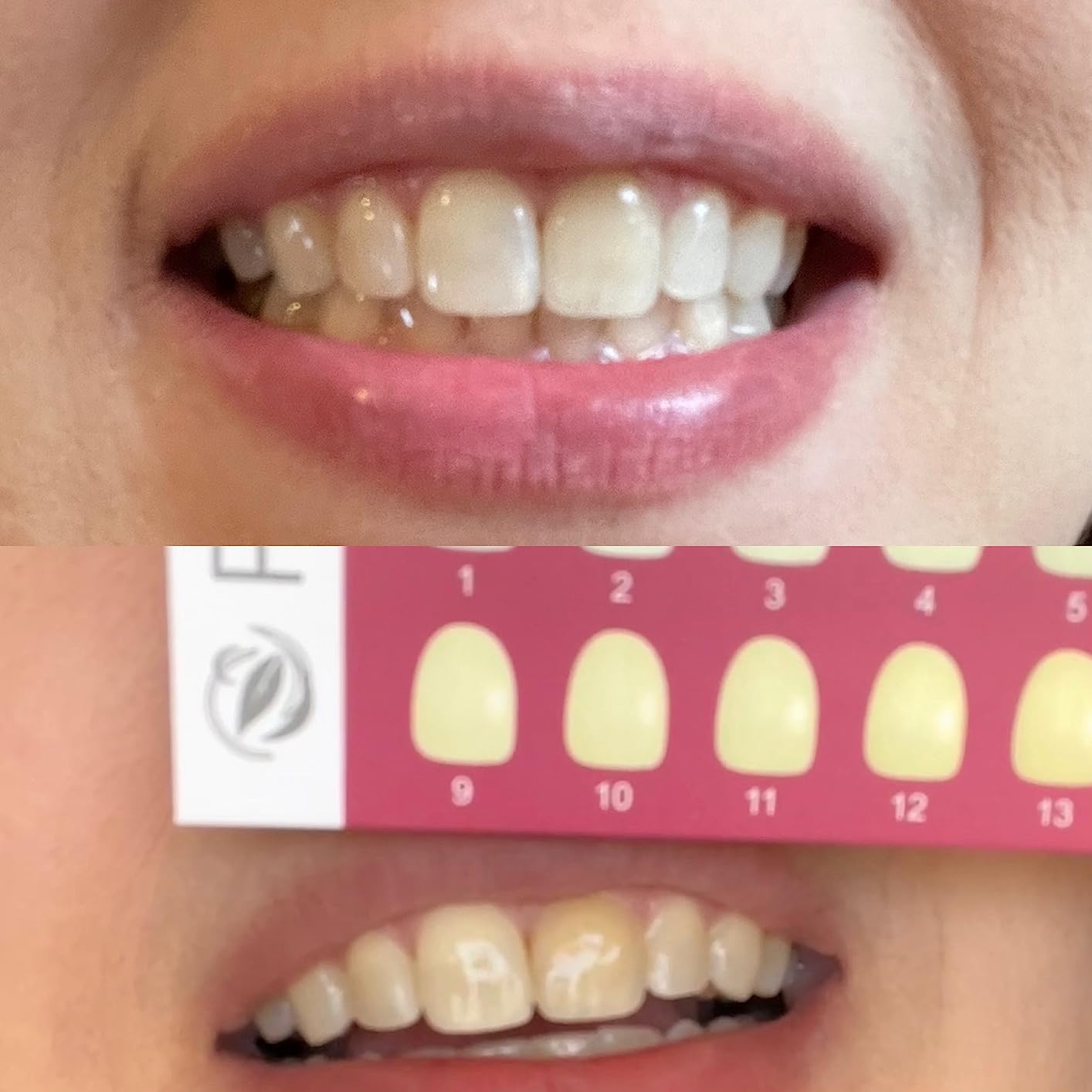 Teeth Whitening Kit with LED Light Tray for Sensitive Teeth, 5 Tooth Whitening Pen Gel Pain Free and Enamel Safe, Teeth Whitener at Home Up to 1-9 Shades Whiter in 1-2 Weeks customer photo 1